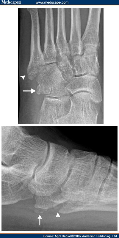 Accessory Ossicles Foot