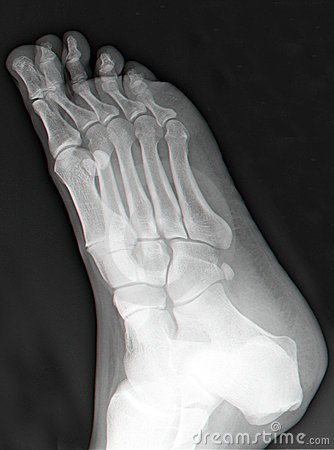 Accessory Ossicles Foot