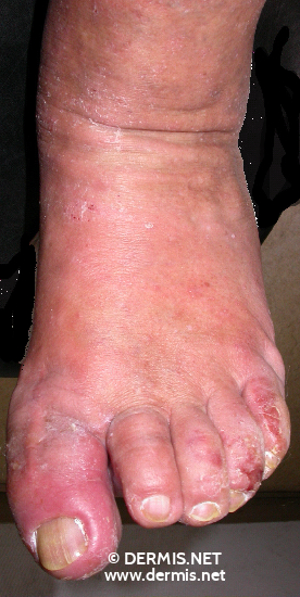 Contact Dermatitis Pictures On Feet