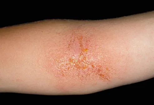 Contact Dermatitis Pictures On Feet